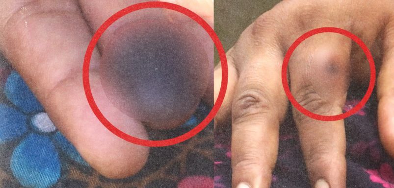 What's causing over 200 mysterious infections in Rangpur district?