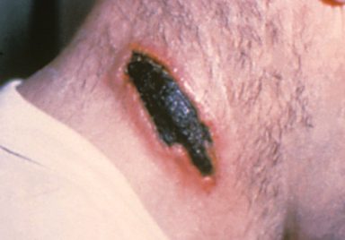 Why Anthrax remains a global concern from livestock to humans?