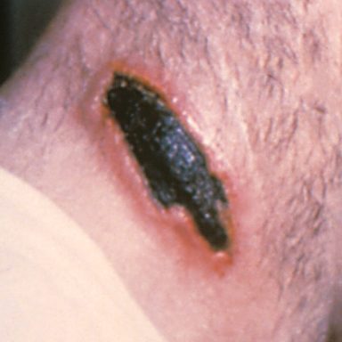 Why Anthrax remains a global concern from livestock to humans?