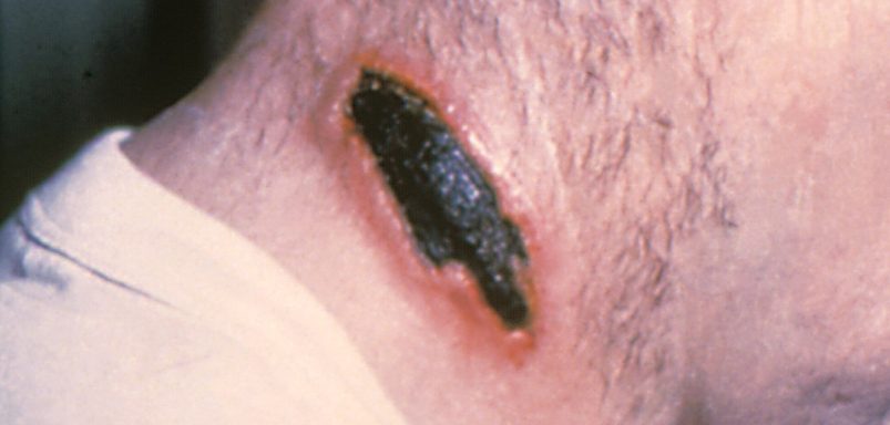 Why Anthrax remains a global concern from livestock to humans?