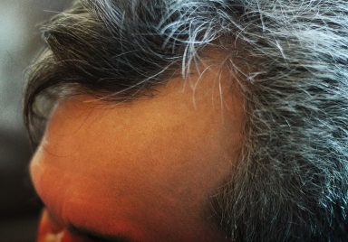 Why more people in their 20s are getting grey hair early and what causes it