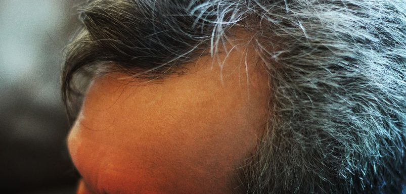 Why more people in their 20s are getting grey hair early and what causes it