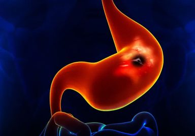 What causes Peptic Ulcers and how can they be treated?