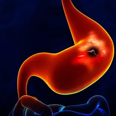 What causes Peptic Ulcers and how can they be treated?
