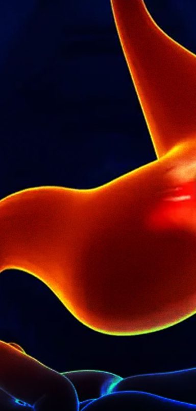 What causes Peptic Ulcers and how can they be treated?