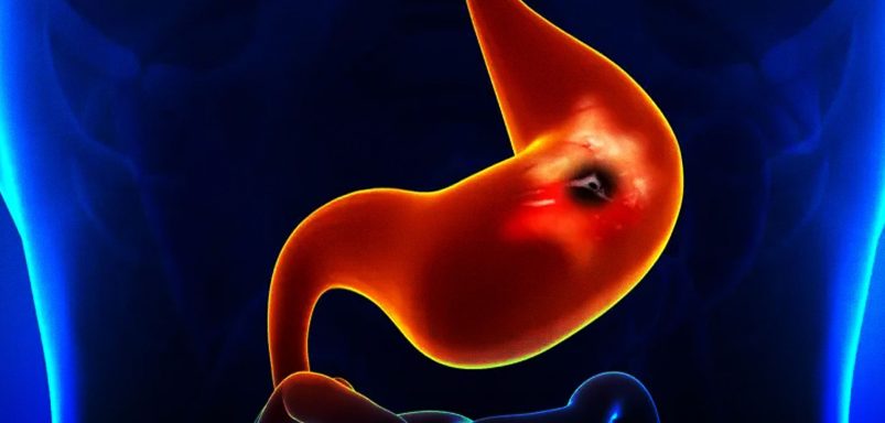 What causes Peptic Ulcers and how can they be treated?