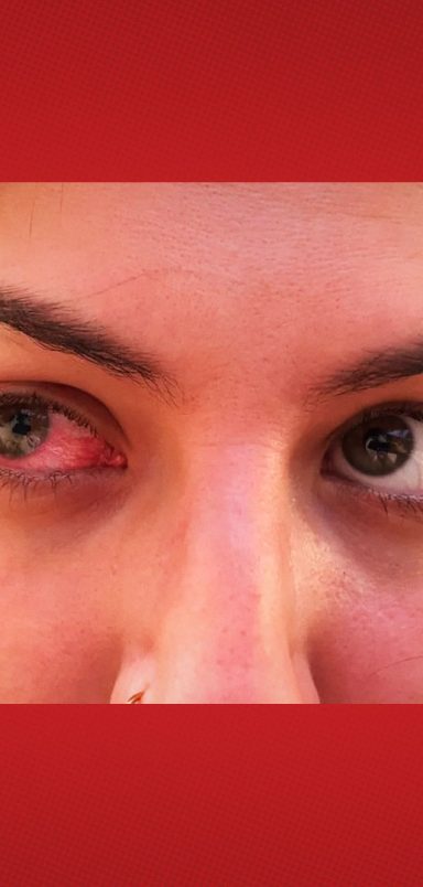 How does a blinding parasitic eye disease infect the eye and how can it be prevented?