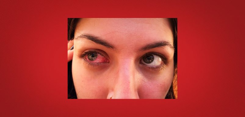 How does a blinding parasitic eye disease infect the eye and how can it be prevented?