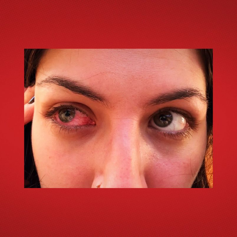 How does a blinding parasitic eye disease infect the eye and how can it be prevented?