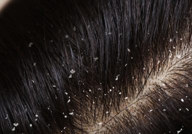 Dermatologist explains different types of dandruff and how to treat them