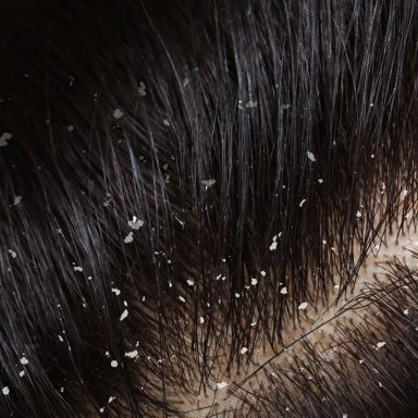 Dermatologist explains different types of dandruff and how to treat them