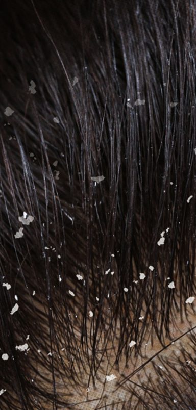 Dermatologist explains different types of dandruff and how to treat them