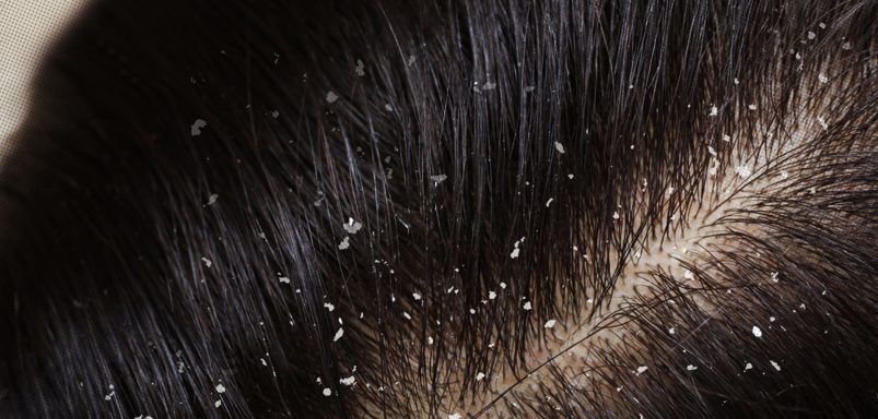 Dermatologist explains different types of dandruff and how to treat them