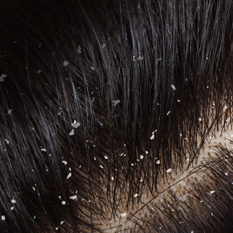 Dermatologist explains different types of dandruff and how to treat them