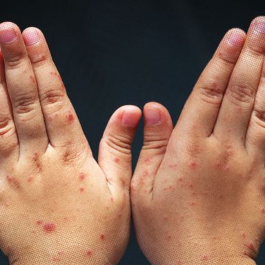 What is driving the measles outbreak in Bangladesh?