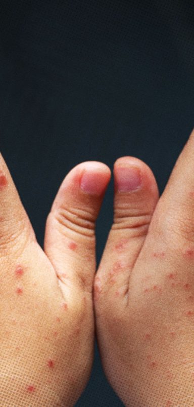 What is driving the measles outbreak in Bangladesh?