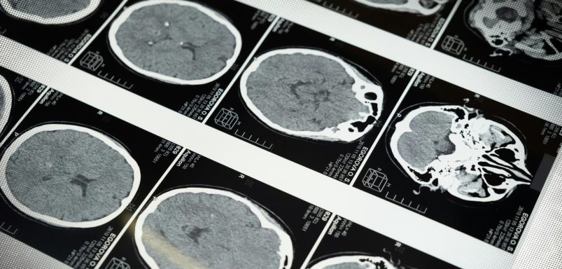 What goes on in the brain of a dying person?