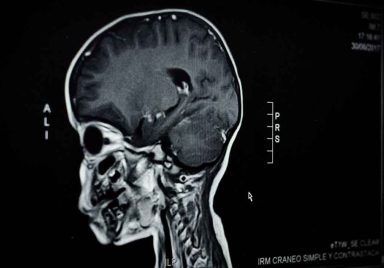 Does malaria leave long-lasting effects on children's brains?