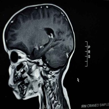 Does malaria leave long-lasting effects on children's brains?