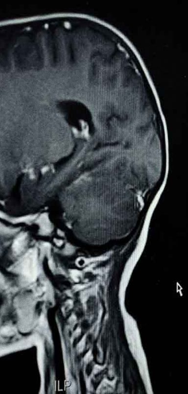 Does malaria leave long-lasting effects on children's brains?