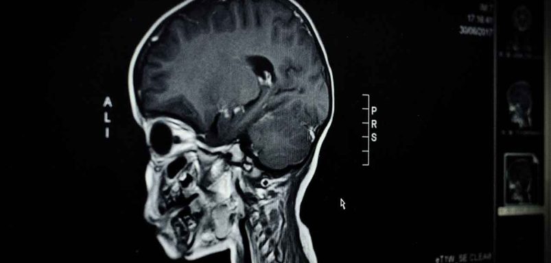 Does malaria leave long-lasting effects on children's brains?