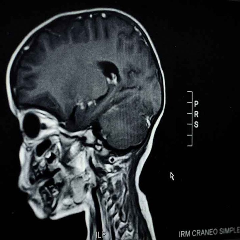 Does malaria leave long-lasting effects on children's brains?