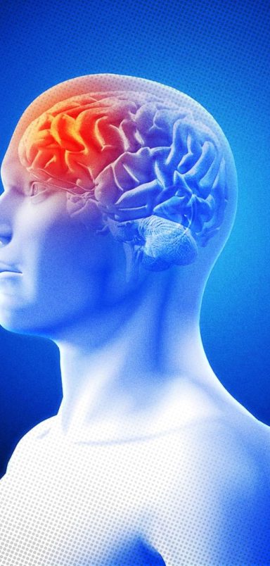 10 things you should know about migraines and how to manage them