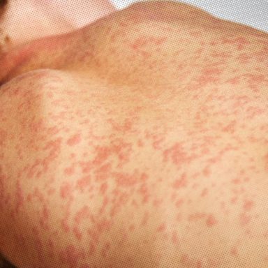 Measles outbreak: Causes, symptoms and prevention