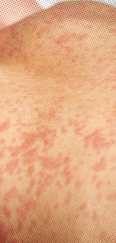 Measles outbreak: Causes, symptoms and prevention