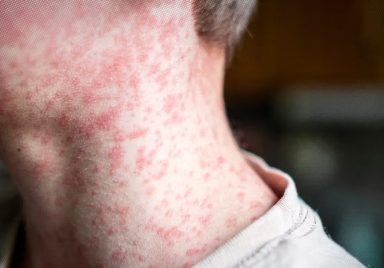 What to do if you get measles as an adult