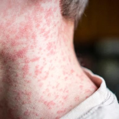 What to do if you get measles as an adult