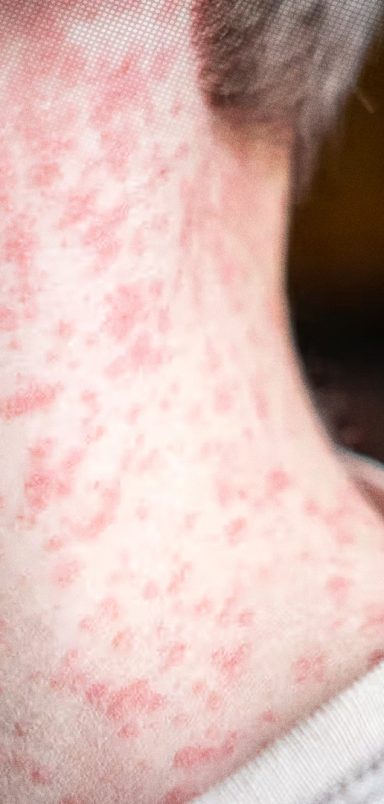 What to do if you get measles as an adult