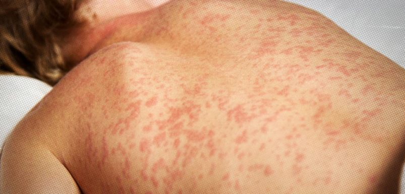 Measles outbreak: Causes, symptoms and prevention
