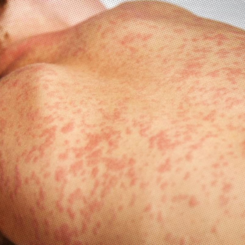 Measles outbreak: Causes, symptoms and prevention