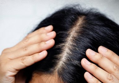6 ways to prevent itchy and greasy scalp in summer