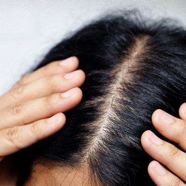 6 ways to prevent itchy and greasy scalp in summer