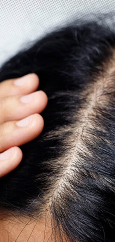 6 ways to prevent itchy and greasy scalp in summer