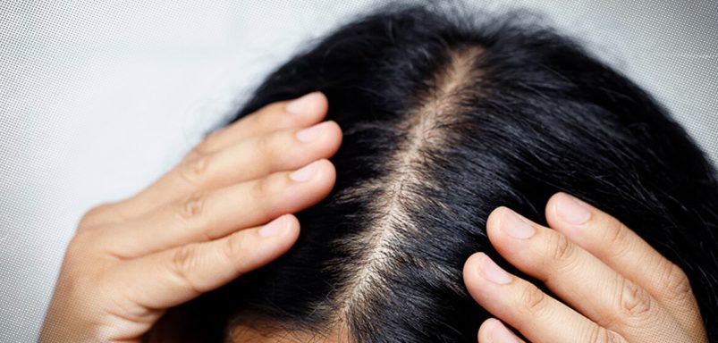 6 ways to prevent itchy and greasy scalp in summer