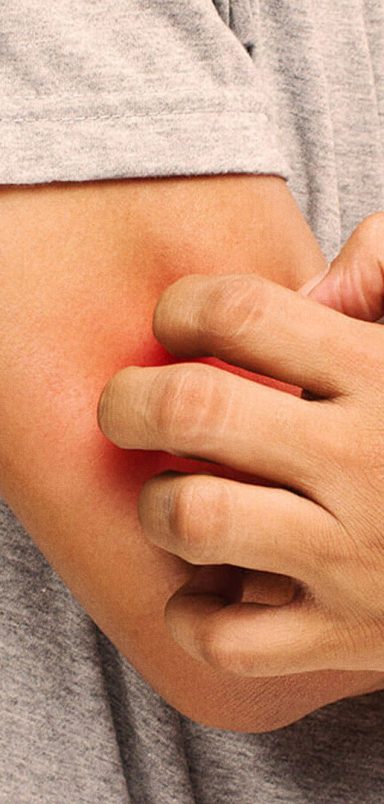 How to control your allergy during Eid?