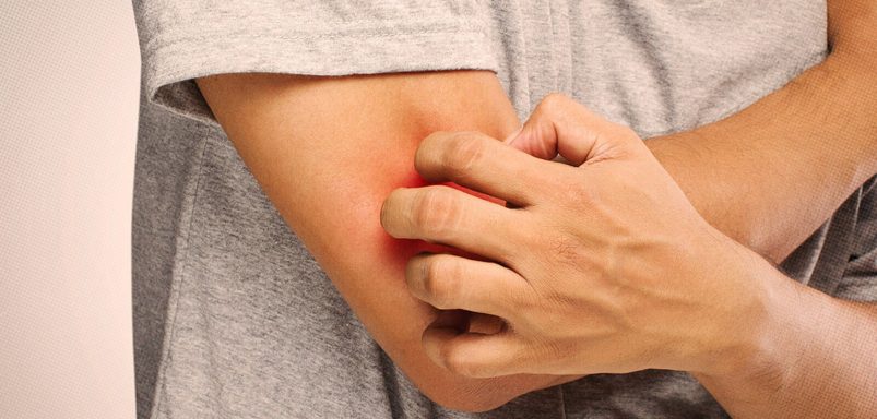 How to control your allergy during Eid?