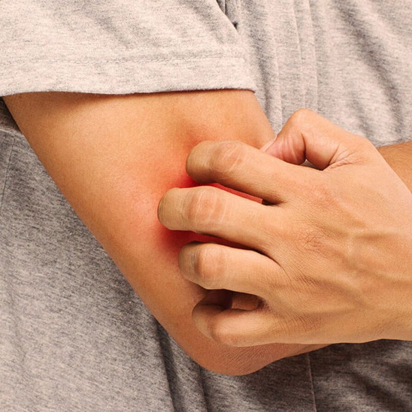 How to control your allergy during Eid?