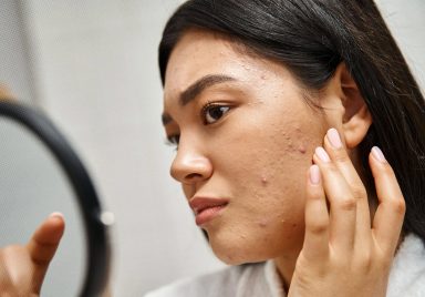How stress can increase acne or skin problems