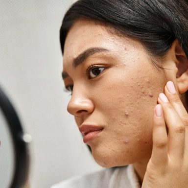 How stress can increase acne or skin problems
