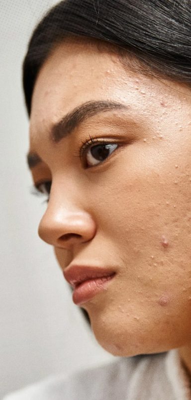 How stress can increase acne or skin problems