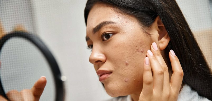 How stress can increase acne or skin problems