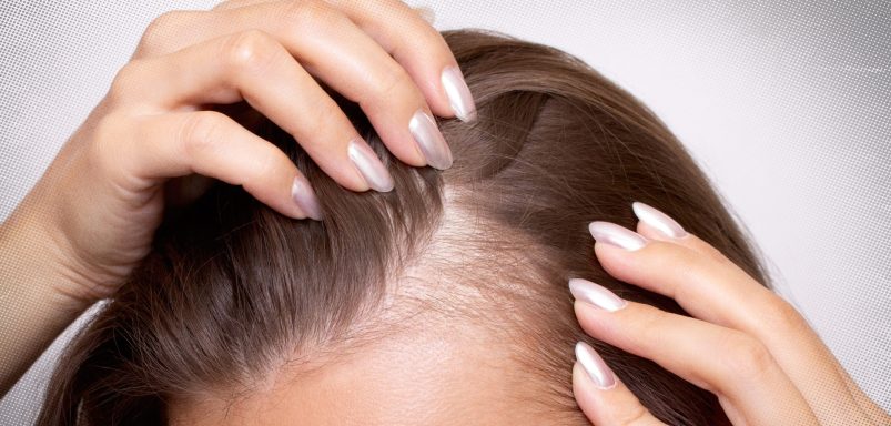 Can you slow down hair loss before it gets worse?