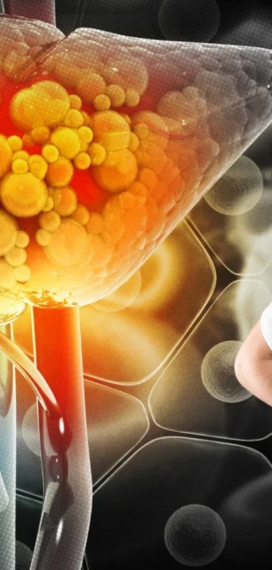 What causes fatty liver disease and how can you prevent it?