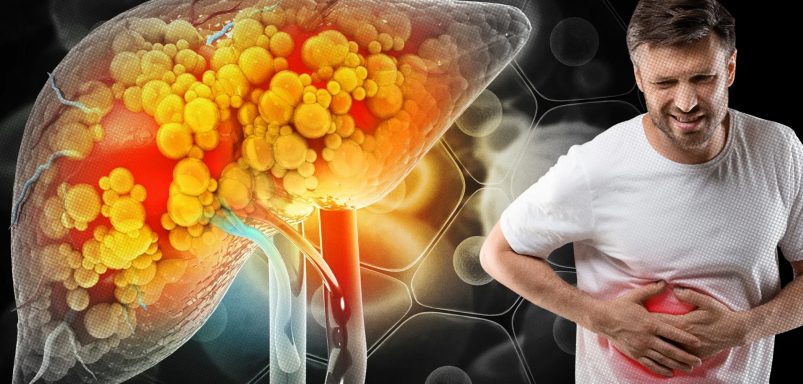 What causes fatty liver disease and how can you prevent it?