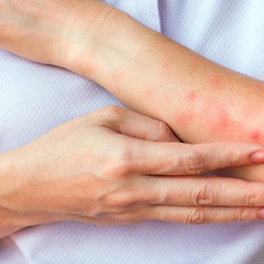 Why scratching a bug bite might feel good but it's a bad idea