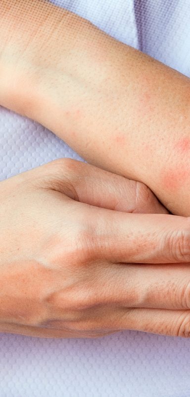 Why scratching a bug bite might feel good but it's a bad idea